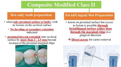 slot preparation in operative dentistry|Class II .
